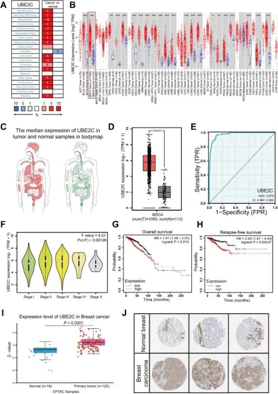 图1 UBE2C在乳腺癌中上调且与不良预后相关