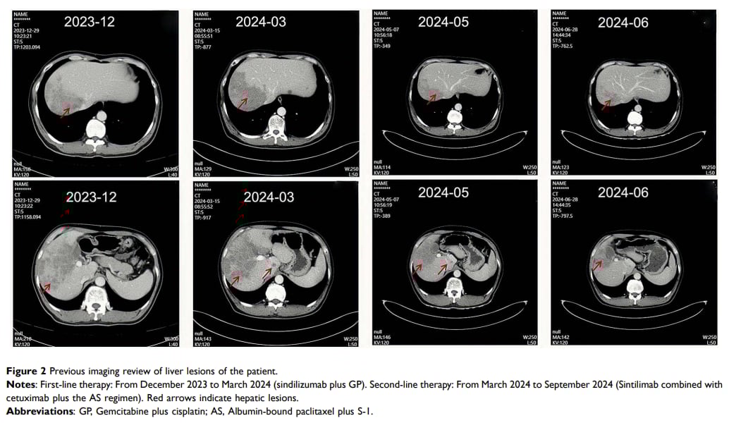 图2 患者肝脏病灶影像学结果