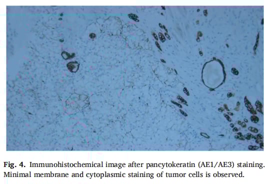 泛细胞角蛋白（AE1/AE3）染色后的免疫组化图像