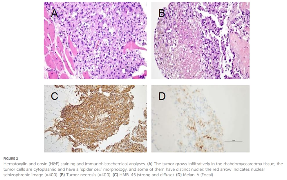 图2 HE染色和免疫组织化学结果