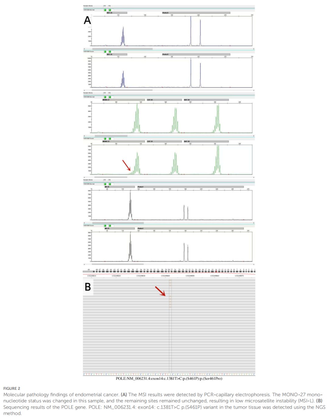 子宫内膜癌的分子病理结果