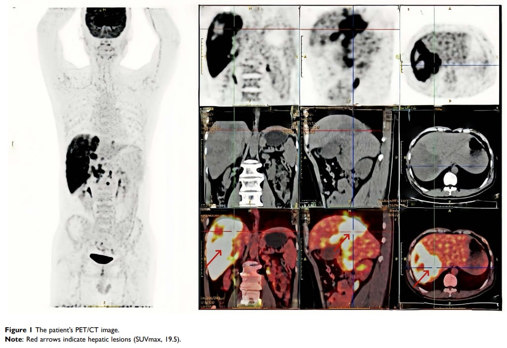图1 患者PET-CT影像