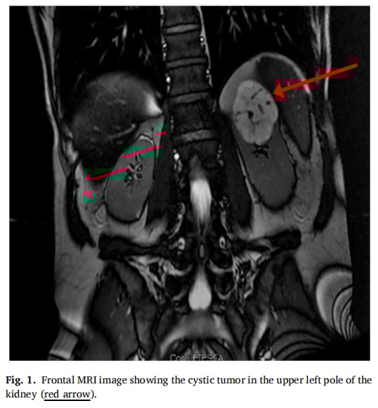 正面MRI图像显示肾脏左上极存在囊性肿瘤