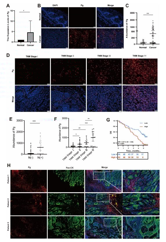 食管鳞癌中牙龈卟啉单胞菌丰度与患者总生存期及预后相关性图