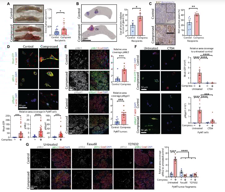 乳腺癌压缩应力通过PIEZO1激活Ca2+与Rho-ROCK通路示意图