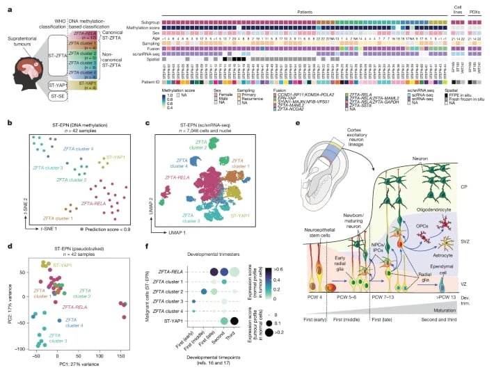 幕上室管膜瘤亚群在人类大脑皮层发育过程中的差异性投射轨迹