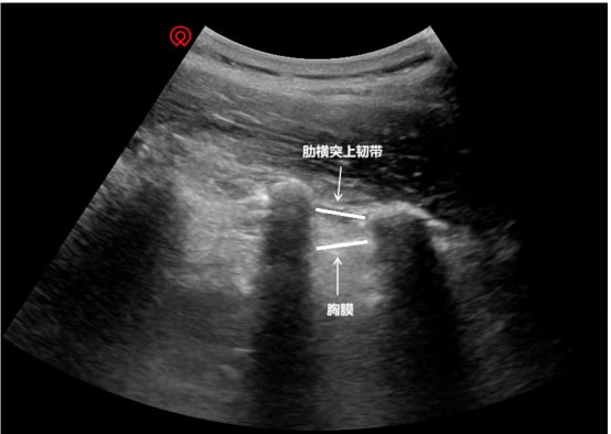 超声引导下的精准定位
