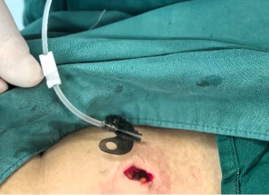 皮下囊袋与港体植入