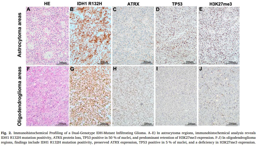 图2 双基因型IDH突变浸润性胶质瘤的免疫组织化学分析