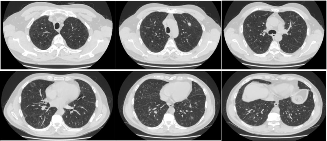 换用阿美替尼后肺癌患者间质性肺炎明显吸收的CT影像