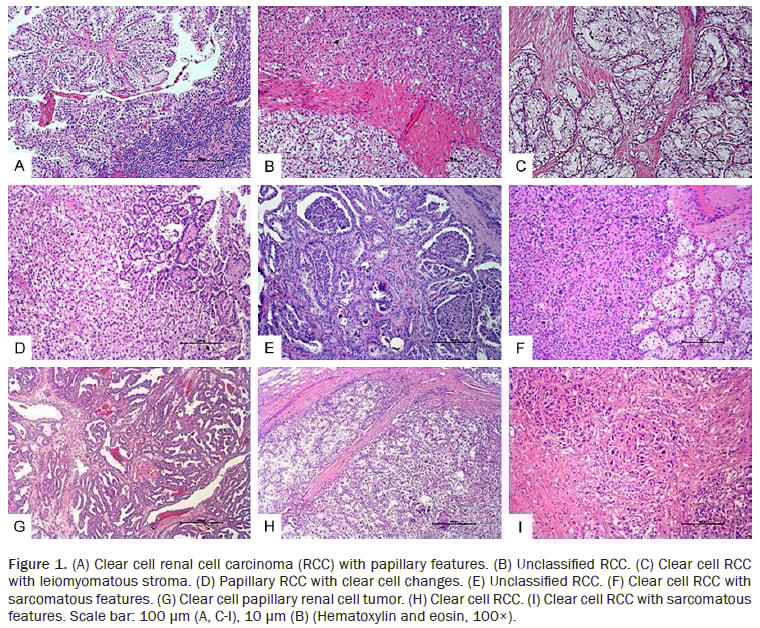 不同形态学特征肾细胞癌的组织病理学图像