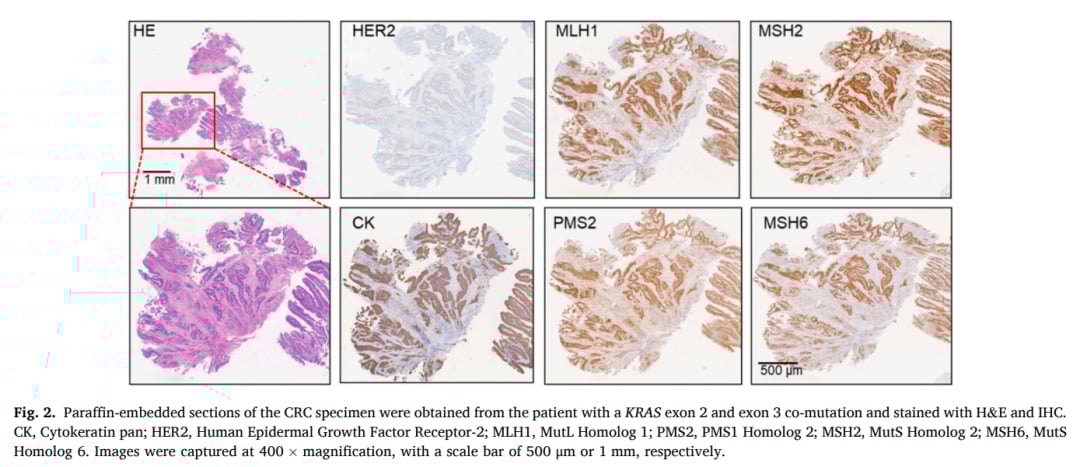结直肠癌石蜡包埋标本的H&E染色与免疫组化染色结果图