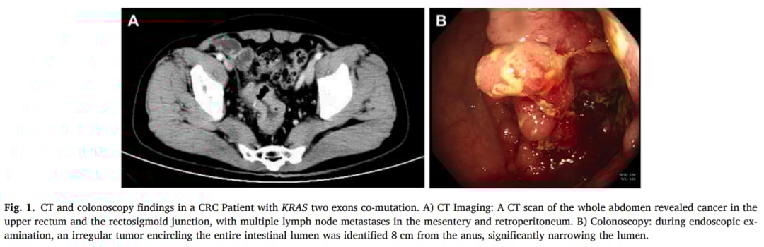 结直肠癌KRAS双外显子共突变患者的腹部CT与结肠镜检查结果图，显示直肠癌灶与淋巴结转移