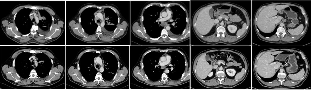 伏美替尼治疗前后肺癌病灶与淋巴结缩小对比图