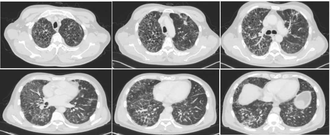 伏美替尼治疗后肺癌患者出现间质性肺炎的CT影像