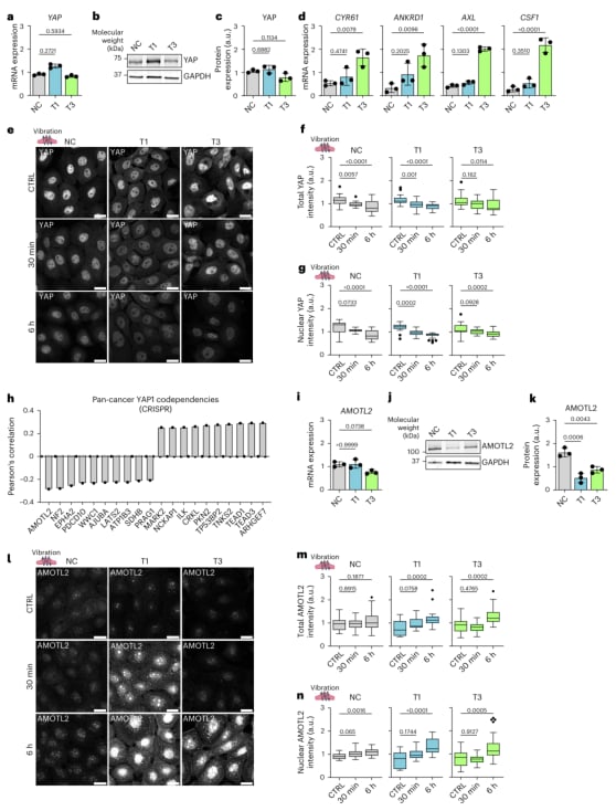 高ECM评分与声带癌患者生存率和YAP表达相关性的临床病理图