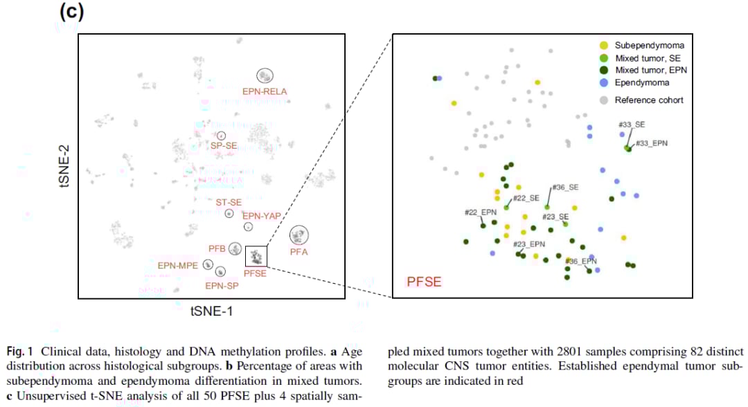 不同组织学表现的PFSE肿瘤统计分析图