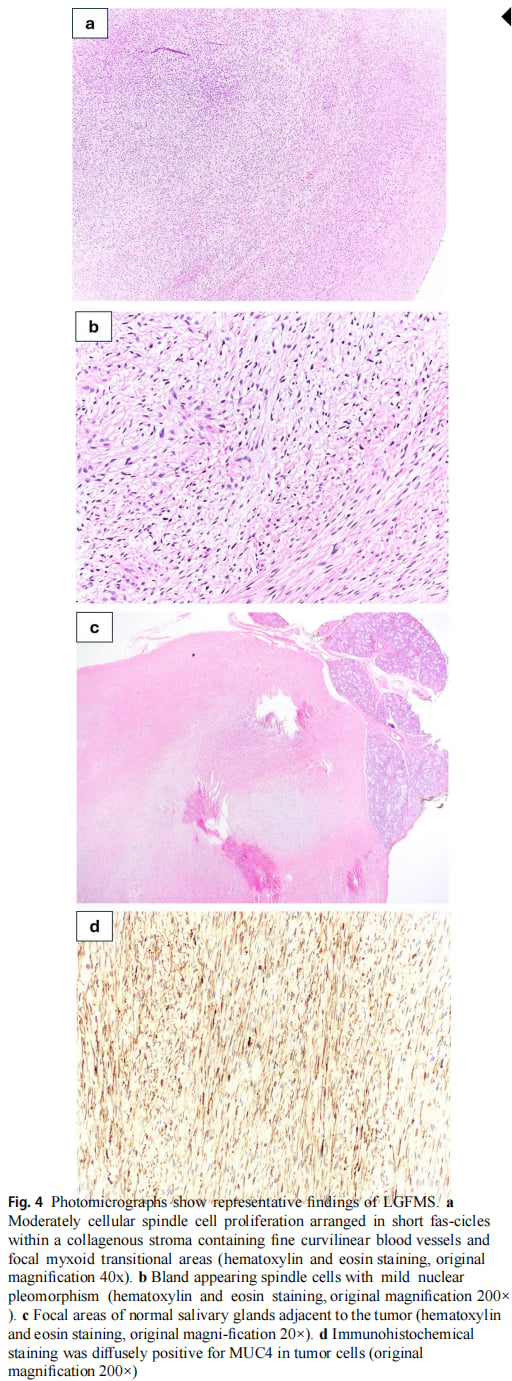 低级别纤维黏液样肉瘤病理形态与MUC4免疫组化特征图