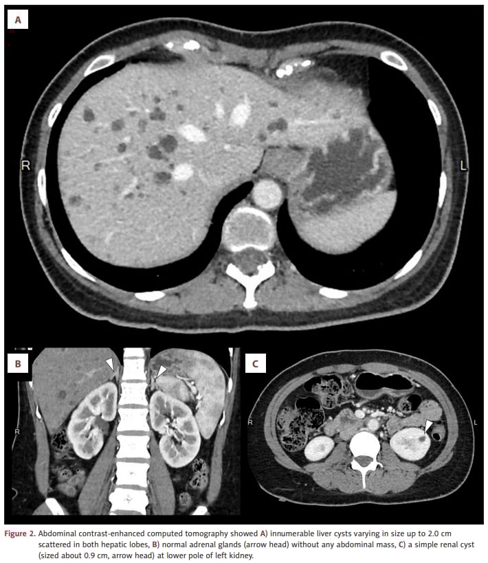 NF1患者合并多囊肝的腹部增强CT：肝囊肿分布、肾上腺正常与单纯性肾囊肿