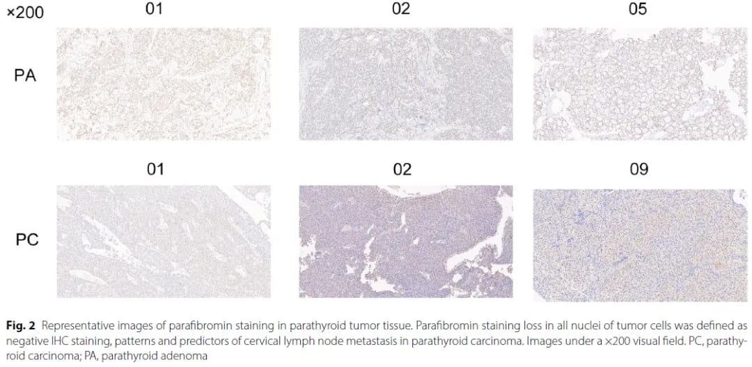 甲状旁腺肿瘤组织免疫组化检测副纤维蛋白表达缺失图示
