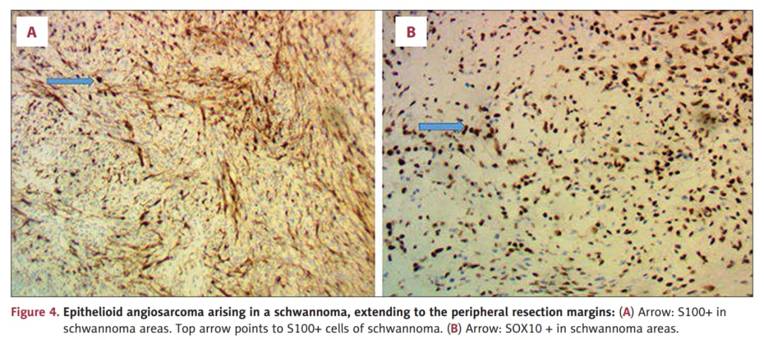上皮样血管肉瘤病理形态与神经鞘瘤背景共存图像