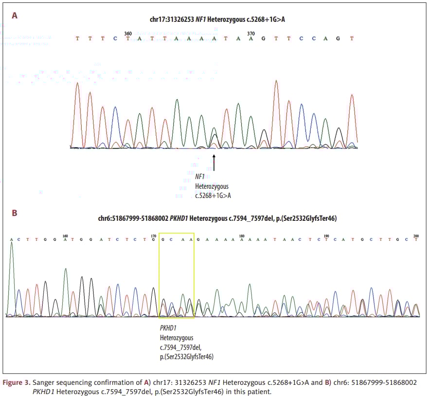 桑格测序验证NF1 c.5268+1G>A与PKHD1 c.7594_7597del杂合致病变异图