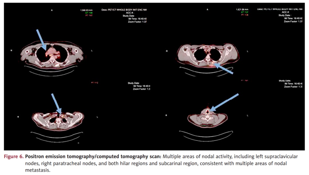 上皮样血管肉瘤PET-CT显示淋巴结及骨转移范围