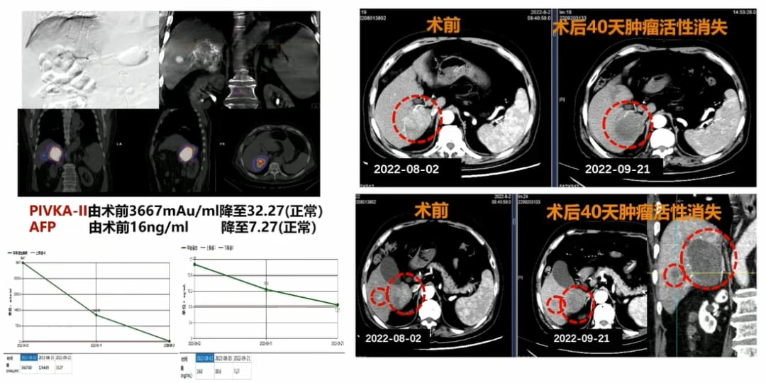 肝细胞癌患者钇90治疗前后影像学变化