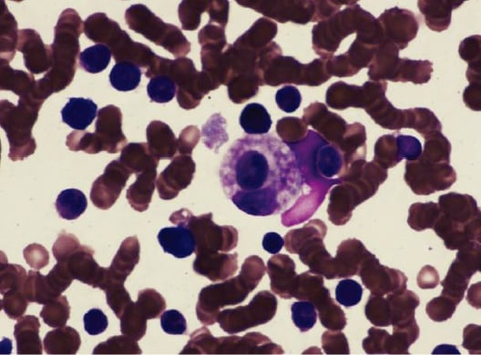 HLH骨髓涂片噬血现象：活化巨噬细胞吞噬红细胞和有核细胞