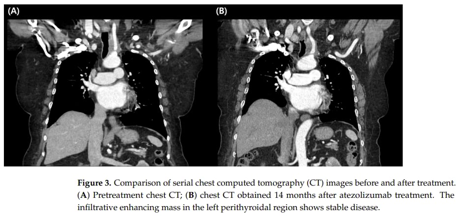 阿替利珠单抗治疗胸腺瘤前后CT影像对比