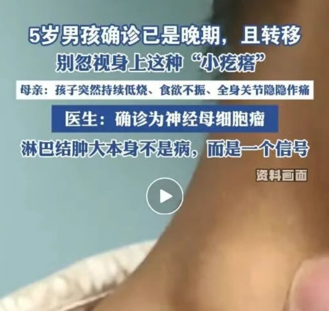 儿童颈部无痛性小疙瘩需警惕神经母细胞瘤早期信号