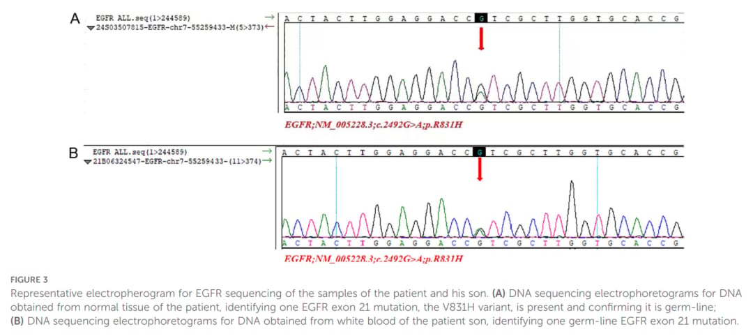EGFR V831H胚系突变家系测序结果提示非小细胞肺癌遗传易感性