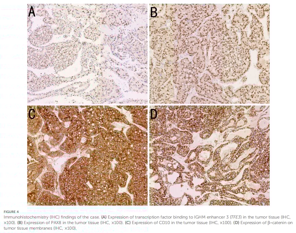 TFE3免疫组化阳性在TFE3易位肾细胞癌精准诊断中的价值