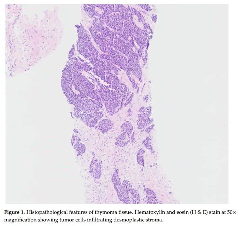 胸腺瘤复发患者的病理组织学特征图