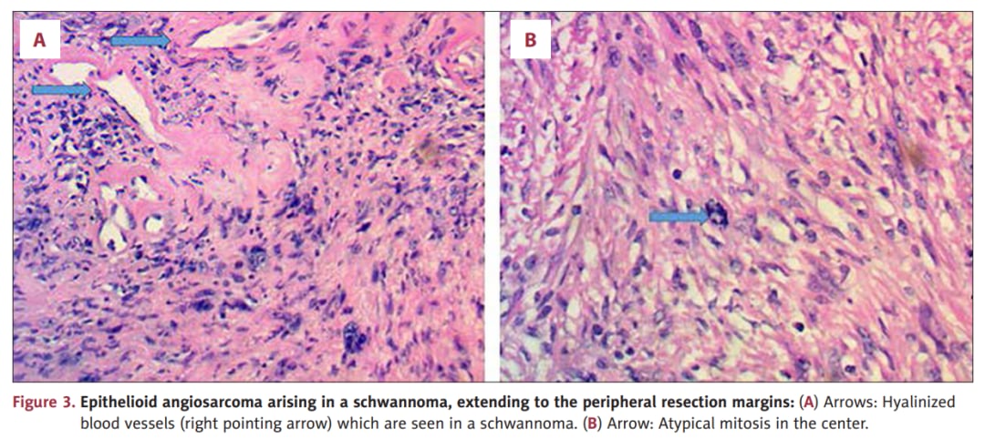 起源于神经鞘瘤的上皮样血管肉瘤病理图像之一