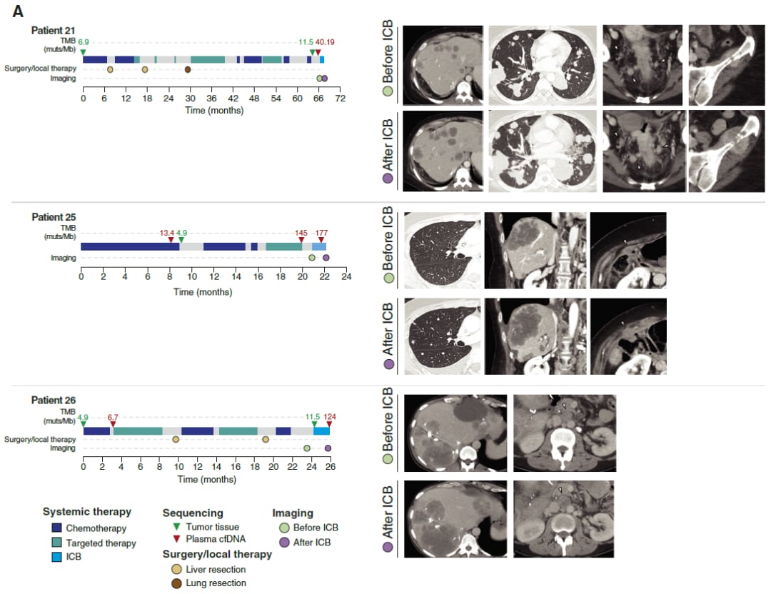 三例高TMB肠癌患者接受帕博利珠单抗治疗的影像学反馈