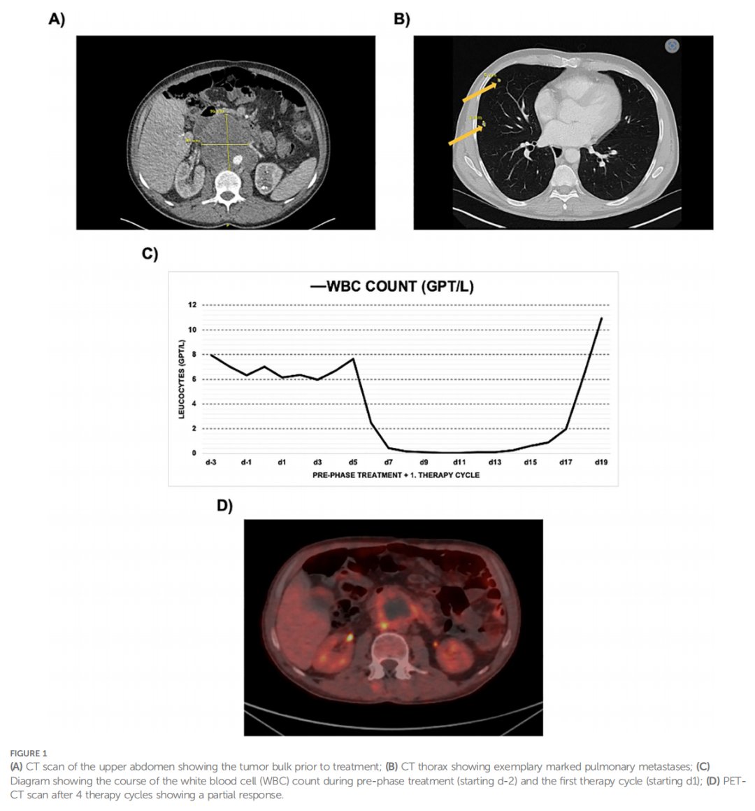 非精原细胞性生殖细胞肿瘤治疗前后影像与白细胞变化：肺转移与化疗后部分缓解