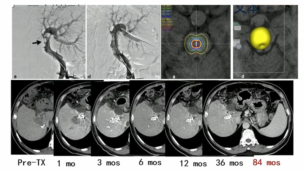 125I粒子支架治疗肝癌门静脉癌栓示意图
