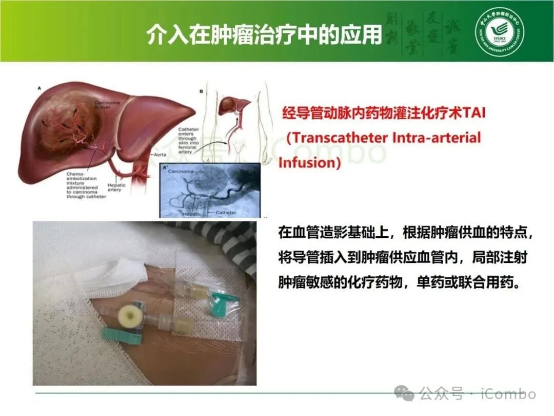 黑色素瘤腹膜转移联合治疗风险与影像评估资料图