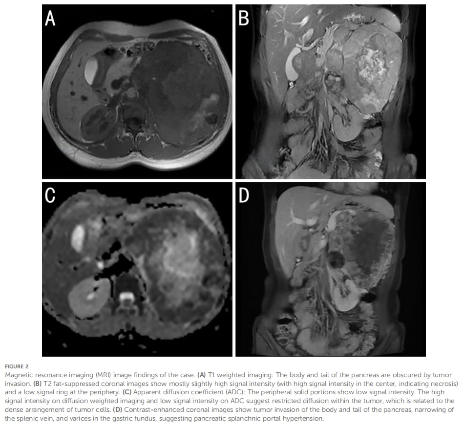 腹膜后巨大肿块MRI表现与TFE3易位肾细胞癌影像误诊风险