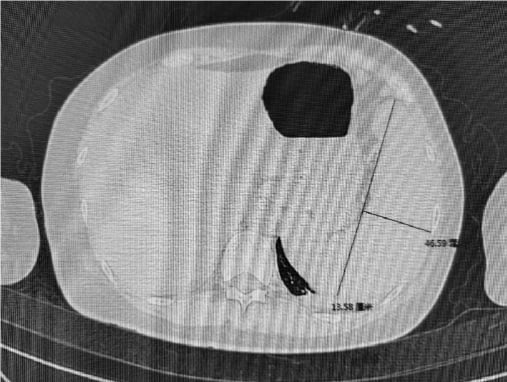 免疫治疗后疑似HLH的腹部CT：脾脏增大提示系统性炎症反应
