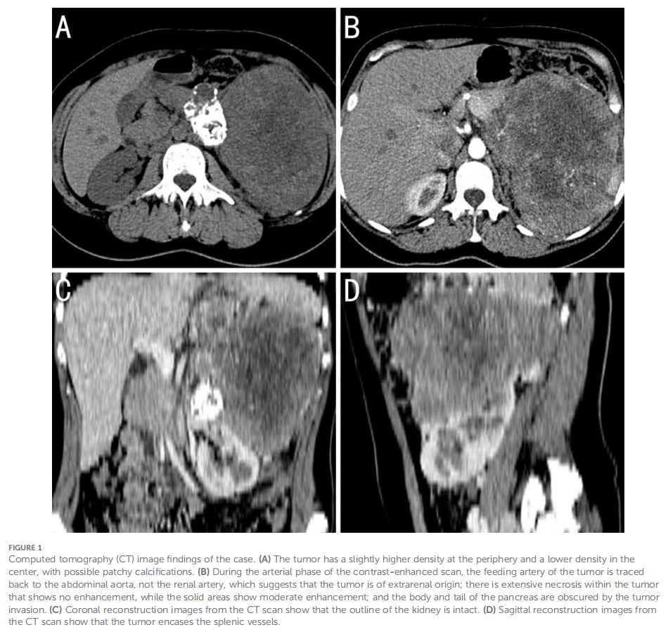 腹膜后肿块CT影像与TFE3易位肾细胞癌鉴别诊断示意