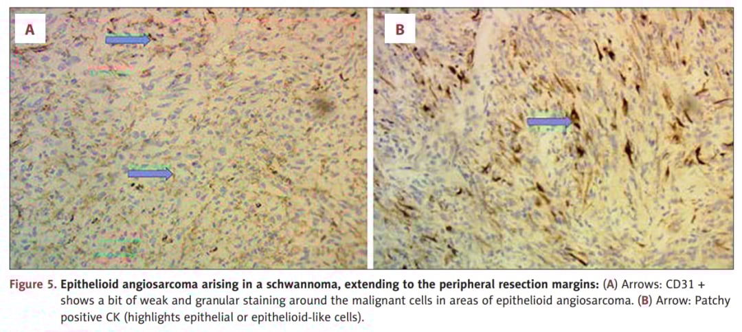 上皮样血管肉瘤切缘阳性病理图像