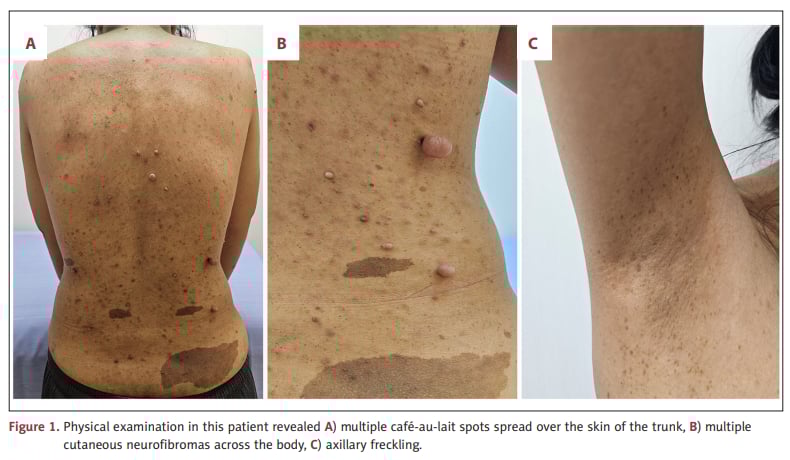 1型神经纤维瘤病NF1皮肤体征：咖啡牛奶斑、皮肤神经纤维瘤与腋窝雀斑示意图