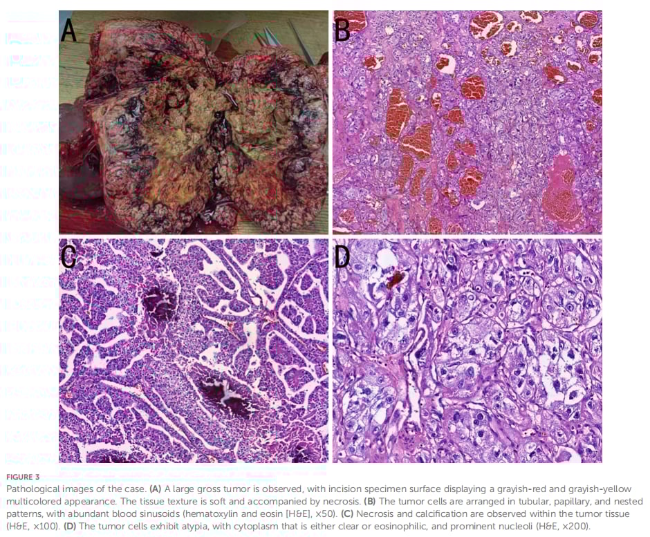 TFE3易位肾细胞癌病理形态特点及术后病理诊断依据