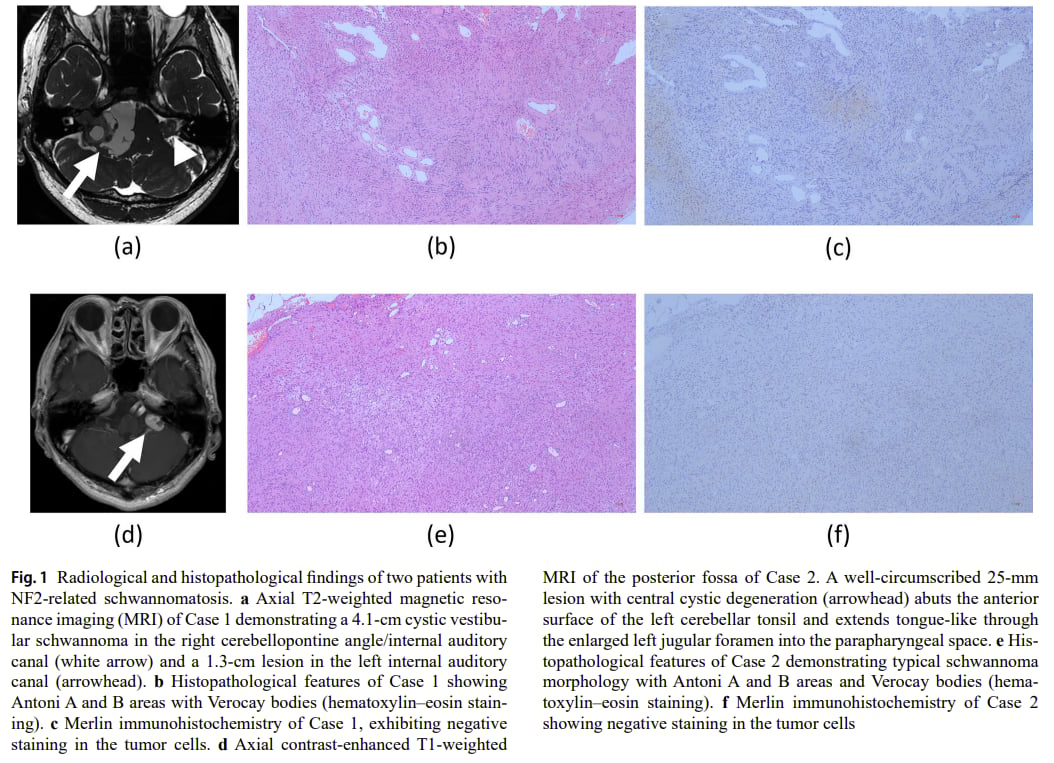 NF2相关神经鞘瘤病患者MRI与病理表现图