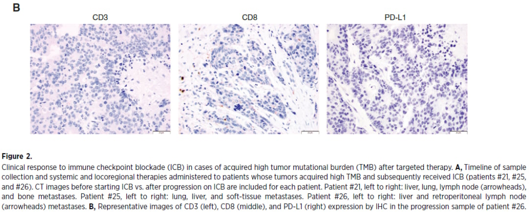 MSS肠癌组织中免疫浸润缺失的病理染色表现