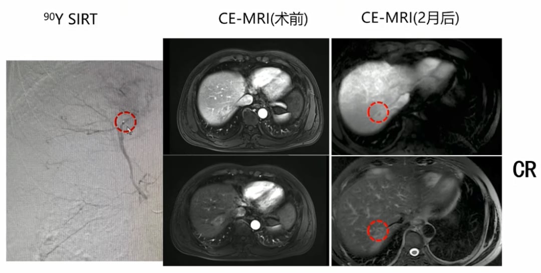 结直肠癌肝转移患者钇90治疗前后影像学变化