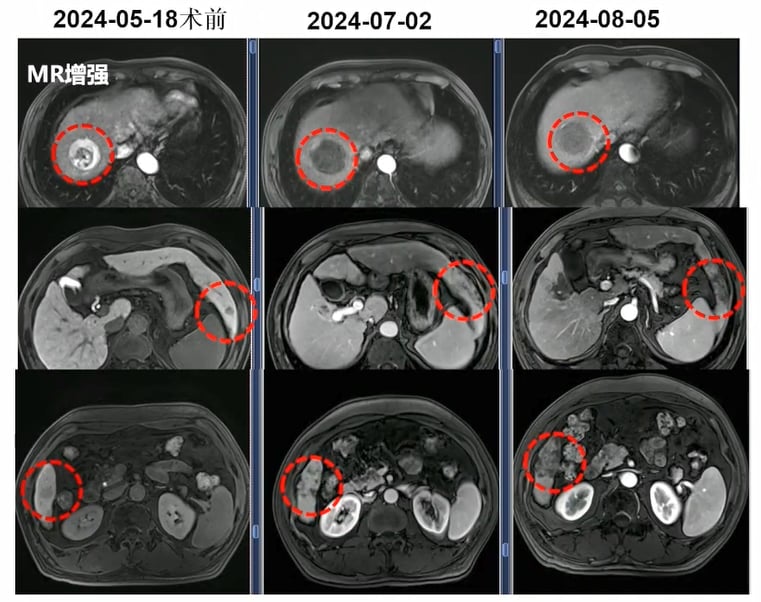 国产钇90微球治疗多发肝癌病灶前后影像学变化