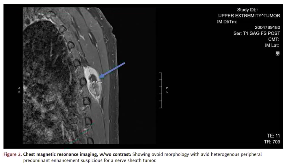 上皮样血管肉瘤胸部MRI强化及范围评估影像